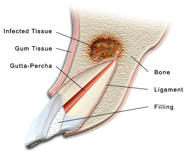 Apicetomy in saravana dental clinic vedarnyam and thiruthuraipoondi